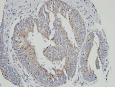 Immunohistochemistry-Paraffin: Cytochrome P450 4A Antibody [NBP1-31427] - Paraffin-embedded mixed OVCA, using antibody at 1:100 dilution.