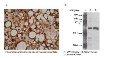 Immunohistochemistry: Cytochrome P450 4F11 Antibody (F21 P6 F5) [NBP2-66614] - A. Immunohistochemical staining of human liposarcoma cells using CYP4F11 antibody (Cat. No. NBP2-66614).B. Western blot using CYP4F11 antibody one normal (2) and cancerous (3) kidney cell lysates.