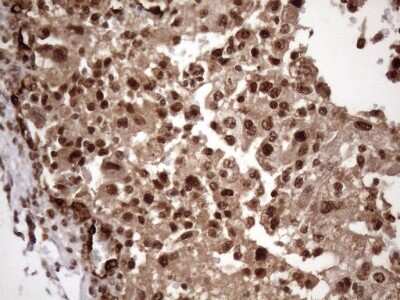 Immunohistochemistry: LIPT2-AS1 Antibody (OTI4C7) [NBP2-45841] - Analysis of Carcinoma of Human kidney tissue.(Heat-induced epitope retrieval by 1mM EDTA in 10mM Tris buffer (pH8.5) at 120C for 3 min)