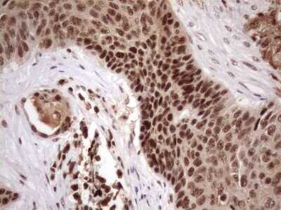 Immunohistochemistry: LIPT2-AS1 Antibody (OTI4C7) [NBP2-45841] - Analysis of Carcinoma of Human lung tissue. Heat-induced epitope retrieval by 1mM EDTA in 10mM Tris buffer (pH8.5) at 120C for 3 min)