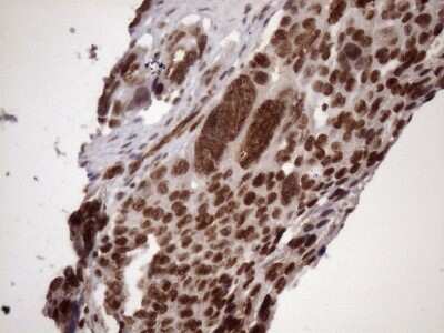 Immunohistochemistry: LIPT2-AS1 Antibody (OTI4C7) [NBP2-45841] - Analysis of Adenocarcinoma of Human ovary tissue. (Heat-induced epitope retrieval by 1mM EDTA in 10mM Tris buffer (pH8.5) at 120C for 3 min)