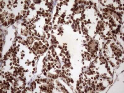 Immunohistochemistry: LIPT2-AS1 Antibody (OTI4C7) [NBP2-45841] - Analysis of Human thyroid tissue. (Heat-induced epitope retrieval by 1mM EDTA in 10mM Tris buffer (pH8.5) at 120C for 3 min)