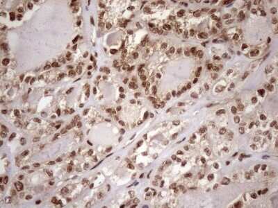 Immunohistochemistry: LIPT2-AS1 Antibody (OTI4C7) [NBP2-45841] - Analysis of Carcinoma of Human thyroid tissue. (Heat-induced epitope retrieval by 1mM EDTA in 10mM Tris buffer (pH8.5) at 120C for 3 min)