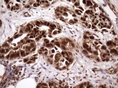 Immunohistochemistry: LIPT2-AS1 Antibody (OTI4C7) [NBP2-45841] - Analysis of Adenocarcinoma of Human endometrium tissue. (Heat-induced epitope retrieval by 1mM EDTA in 10mM Tris buffer (pH8.5) at 120C for 3 min)