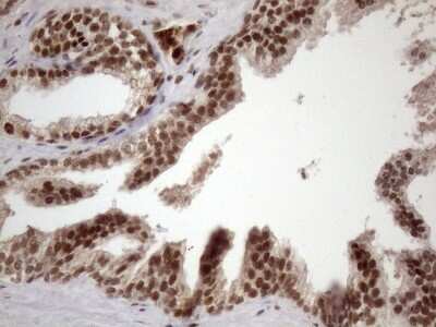 Immunohistochemistry: LIPT2-AS1 Antibody (OTI4C7) [NBP2-45841] - Analysis of Carcinoma of Human prostate tissue. (Heat-induced epitope retrieval by 1mM EDTA in 10mM Tris buffer (pH8.5) at 120C for 3 min)