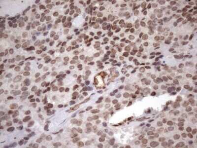 Immunohistochemistry: LIPT2-AS1 Antibody (OTI4C7) - Azide and BSA Free [NBP2-71949] - Analysis of Adenocarcinoma of Human breast tissue. (Heat-induced epitope retrieval by 1mM EDTA in 10mM Tris buffer (pH8.5) at 120C for 3 min)
