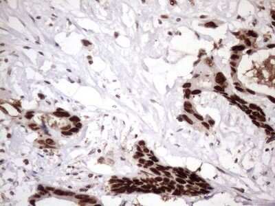 Immunohistochemistry: LIPT2-AS1 Antibody (OTI4C7) - Azide and BSA Free [NBP2-71949] - Analysis of Adenocarcinoma of Human colon. (Heat-induced epitope retrieval by 1mM EDTA in 10mM Tris buffer (pH8.5) at 120C for 3 min)