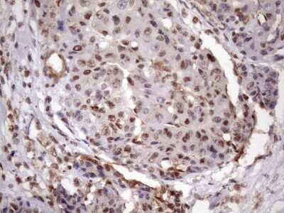 Immunohistochemistry: LIPT2-AS1 Antibody (OTI4C7) - Azide and BSA Free [NBP2-71949] - Analysis of Carcinoma of Human liver tissue.(Heat-induced epitope retrieval by 1mM EDTA in 10mM Tris buffer (pH8.5) at 120C for 3 min)