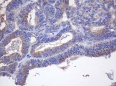 Immunohistochemistry: Cytochrome p450 2J2 Antibody (5C9) [NBP2-46419] - Analysis of Adenocarcinoma of Human endometrium tissue. (Heat-induced epitope retrieval by 10mM citric buffer, pH6.0, 120C for 3min)