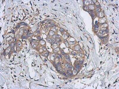 Immunohistochemistry-Paraffin: Cytochrome p450 2J2 Antibody [NBP2-16079] - Analysis of paraffin-embedded Breast ca, using antibody at 1:500 dilution.