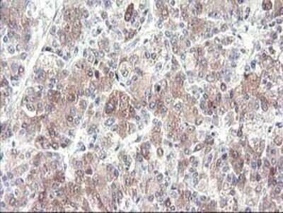 Immunohistochemistry: Cytochrome p450 2J2 Antibody (OTI5C5) - Azide and BSA Free [NBP2-70539] - Staining of paraffin-embedded Carcinoma of Human liver tissue using anti-Cytochrome p450 2J2 mouse monoclonal antibody.