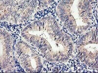 Immunohistochemistry-Paraffin: Cytochrome p450 2J2 Antibody (OTI5C5) [NBP2-01286] - Staining of paraffin-embedded Adenocarcinoma of Human endometrium tissue using anti-Cytochrome p450 2J2 mouse monoclonal antibody.