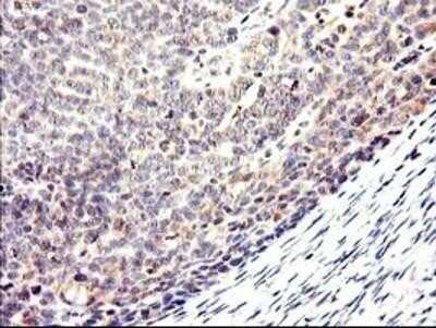 Immunohistochemistry-Paraffin: Cytochrome p450 2J2 Antibody (OTI5C5) [NBP2-01286] - Staining of paraffin-embedded Adenocarcinoma of Human ovary tissue using anti-Cytochrome p450 2J2 mouse monoclonal antibody.