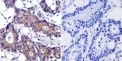 Immunohistochemistry-Paraffin: Cytohesin 2 Antibody (10A12) [NBP2-22514] - Cancer biopsies of deparaffinized Human colon carcinoma tissue.