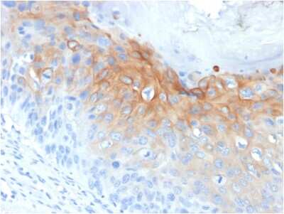 Immunohistochemistry-Paraffin: Cytokeratin 1 Antibody (KRT1/1840) - Azide and BSA Free [NBP3-08475] - Formalin-fixed, paraffin-embedded human Cervical Carcinoma stained with Cytokeratin 1 Mouse Monoclonal Antibody (KRT1/1840).