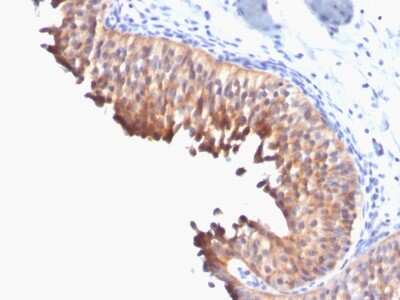 Immunohistochemistry-Paraffin: Cytokeratin 10 Antibody (DE-K10) [NBP2-54402] - Formalin-fixed, paraffin-embedded human Bladder Carcinoma stained with Cytokeratin 10 Monoclonal Antibody (DE-K10).