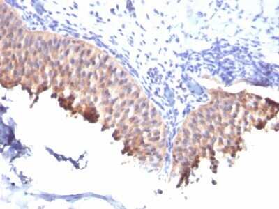 Immunohistochemistry-Paraffin: Cytokeratin 10 Antibody (SPM261) - Azide and BSA Free [NBP2-34752] - Formalin-fixed, paraffin-embedded human Bladder Carcinoma stained with Cytokeratin 10 Antibody (SPM261).