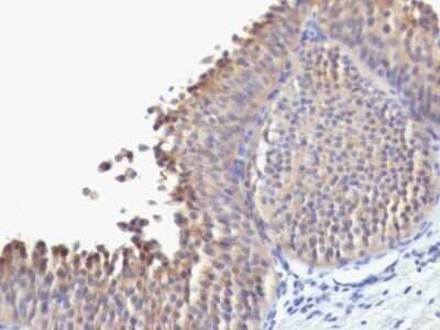 Immunohistochemistry-Paraffin: Cytokeratin 10 Antibody (SPM623) [NBP2-54332] - Formalin-fixed, paraffin-embedded human Bladder Carcinoma stained with Cytokeratin 10 Monoclonal Antibody (SPM623).