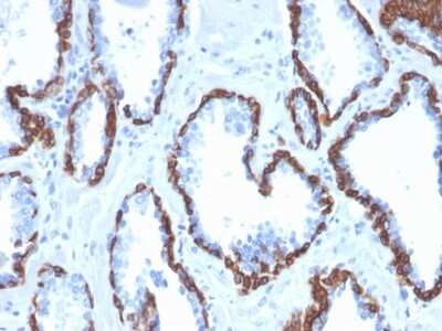 Immunohistochemistry-Paraffin: Cytokeratin 13 Antibody (KRT13/2659) - Azide and BSA Free [NBP3-08284] - Formalin-fixed, paraffin-embedded human Prostate Carcinoma stained with Cytokeratin 13 Mouse Monoclonal Antibody (KRT13/2659).