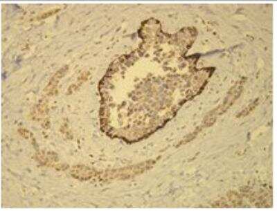 Immunohistochemistry-Paraffin: Cytokeratin 14 Antibody (D19-N) [NBP1-79069] - CK14 expression in the myoepithelial cells of DCIS of the breast. Formalin fixed, paraffin embedded human tissues (4 um sections) stained with anti-Cytokeratin 14 monospecific clonal antibody.