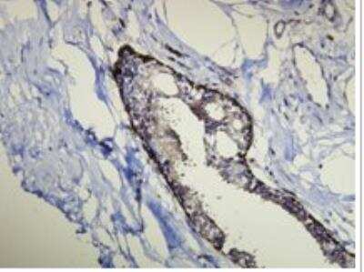 Immunohistochemistry-Paraffin: Cytokeratin 14 Antibody (D19-N) [NBP1-79069] - CK14 expression in ductal myoepithelial cells of the breast. Formalin fixed, paraffin embedded human tissues (4 um sections) stained with anti-Cytokeratin 14 monospecific clonal antibody.