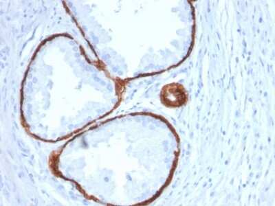 Immunohistochemistry-Paraffin: Cytokeratin 14 Antibody (KRT14/2375) - Azide and BSA Free [NBP3-08531] - Formalin-fixed, paraffin-embedded human Prostate Carcinoma stained with Cytokeratin 14 Mouse Monoclonal Antibody (KRT14/2375).