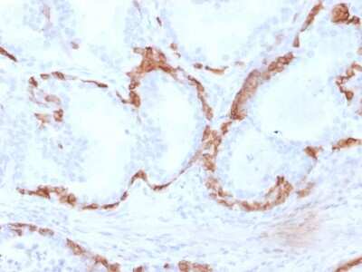 Immunohistochemistry-Paraffin: Cytokeratin 14 Antibody (KRT14/2375) - Azide and BSA Free [NBP3-08531] - Formalin-fixed, paraffin-embedded human Prostate Carcinoma stained with Cytokeratin 14 Mouse Monoclonal Antibody (KRT14/2375).