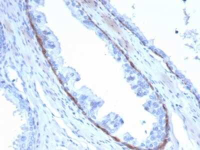 Immunohistochemistry-Paraffin: Cytokeratin 14 Antibody (KRT14/4132) [NBP3-07849] - Formalin-fixed, paraffin-embedded human prostate stained with Cytokeratin 14 Mouse Monoclonal Antibody (KRT14/4132).