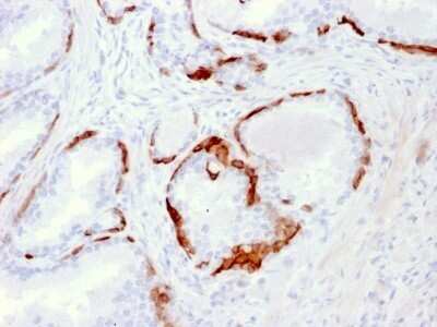 Immunohistochemistry-Paraffin: Cytokeratin 14 Antibody (LL002) - IHC-Prediluted [NBP2-45029] - Formalin-fixed, paraffin-embedded human Prostate Carcinoma stained with Cytokeratin 14 Antibody (LL002).