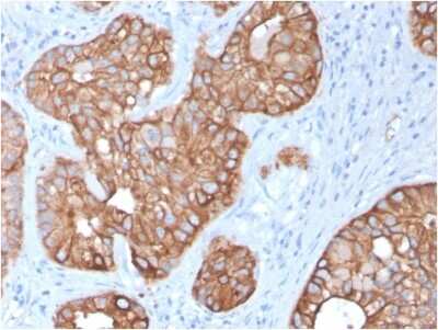Immunohistochemistry-Paraffin: Cytokeratin 15 Antibody (KRT15/2957) - Azide and BSA Free [NBP3-08478] - Formalin-fixed, paraffin-embedded human Colon Carcinoma stained with Cytokeratin 15 Mouse Monoclonal Antibody (KRT15/2957)