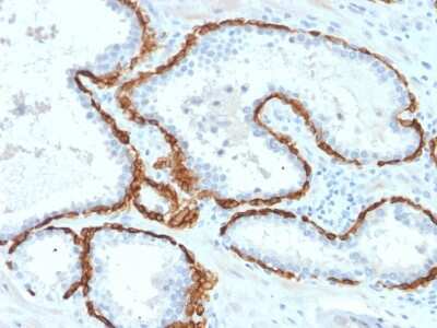 Immunohistochemistry-Paraffin: Cytokeratin 15 Antibody (KRT15/2958) [NBP3-07614] - Formalin-fixed, paraffin-embedded human Prostate Carcinoma stained with Cytokeratin 15 Mouse Monoclonal Antibody (KRT15/2958).