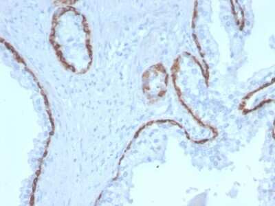 Immunohistochemistry-Paraffin: Cytokeratin 15 Antibody (KRT15/2958) [NBP3-08569] - Formalin-fixed, paraffin-embedded human Prostate Carcinoma stained with Cytokeratin 15 Mouse Monoclonal Antibody (KRT15/2958).