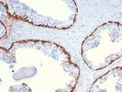 Immunohistochemistry-Paraffin: Cytokeratin 15 Antibody (KRT15/2959) - Azide and BSA Free [NBP3-08599] - Formalin-fixed, paraffin-embedded human Prostate Carcinoma stained with Cytokeratin 15 Mouse Monoclonal Antibody (KRT15/2959)