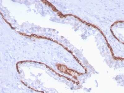 Immunohistochemistry-Paraffin: Cytokeratin 15 Antibody (KRT15/2959) - Azide and BSA Free [NBP3-08599] - Formalin-fixed, paraffin-embedded human Prostate Carcinoma stained with Cytokeratin 15 Mouse Monoclonal Antibody (KRT15/2959).