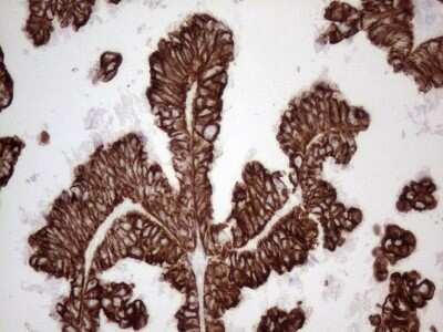 Immunohistochemistry: Cytokeratin 16 Antibody (2H8) [NBP2-45538] - Analysis of Adenocarcinoma of Human ovary tissue. (Heat-induced epitope retrieval by 1mM EDTA in 10mM Tris buffer (pH8.5) at 120C for 3 min)