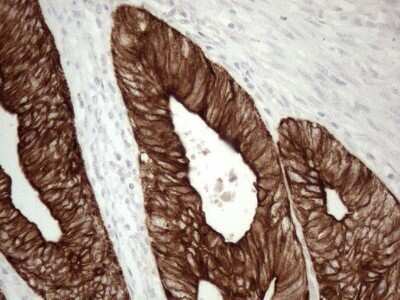 Immunohistochemistry: Cytokeratin 16 Antibody (OTI2H8) - Azide and BSA Free [NBP2-71085] - Analysis of Adenocarcinoma of Human colon tissue. (Heat-induced epitope retrieval by 1mM EDTA in 10mM Tris buffer (pH8.5) at 120C for 3 min)