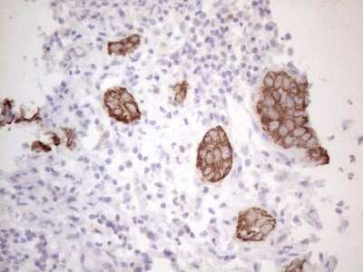 Immunohistochemistry: Cytokeratin 16 Antibody (OTI2H8) - Azide and BSA Free [NBP2-71085] - Analysis of Carcinoma of Human bladder tissue (Heat-induced epitope retrieval by 1mM EDTA in 10mM Tris buffer (pH8.5) at 120C for 3 min)