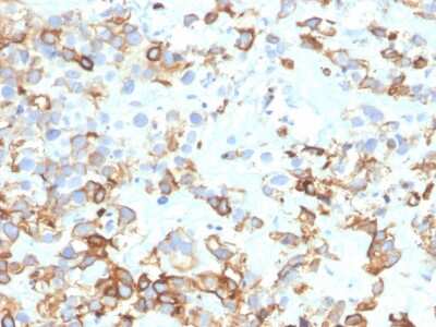 Immunohistochemistry-Paraffin: Cytokeratin 17 Antibody (KRT17/4604) - Azide and BSA Free [NBP3-08541] - Formalin-fixed, paraffin-embedded human bladder carcinoma stained with Cytokeratin 17 Mouse Monoclonal Antibody (KRT17/4604).
