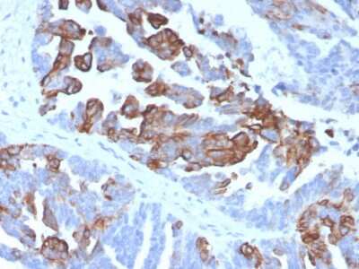 Immunohistochemistry-Paraffin: Cytokeratin 17 Antibody (KRT17/4604) - Azide and BSA Free [NBP3-08541] - Formalin-fixed, paraffin-embedded human prostate stained with Cytokeratin 17 Mouse Monoclonal Antibody (KRT17/4604).