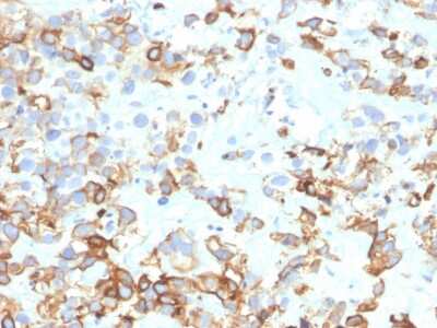 Immunohistochemistry-Paraffin: Cytokeratin 17 Antibody (KRT17/4604) [NBP3-07682] - Formalin-fixed, paraffin-embedded human bladder carcinoma stained with Cytokeratin 17 Mouse Monoclonal Antibody (KRT17/4604).