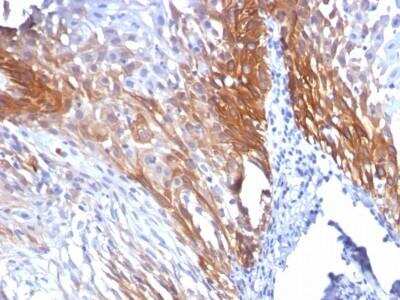 Immunohistochemistry-Paraffin: Cytokeratin 17 Antibody (KRT17/778) - Azide and BSA Free [NBP2-47684] - Human Cervical Carcinoma stained with CK17 Monoclonal Antibody (KRT17/778).