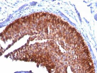 Immunohistochemistry-Paraffin: Cytokeratin 17 Antibody (KRT17/778) - Azide and BSA Free [NBP2-47684] - Human Bladder Carcinoma stained with CK17 Monoclonal Antibody (KRT17/778).