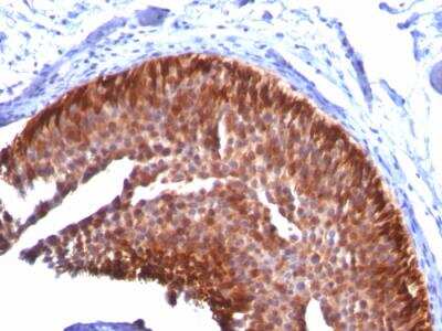 Immunohistochemistry-Paraffin: Cytokeratin 17 Antibody (KRT17/778) - IHC-Prediluted [NBP2-48047] - Formalin-fixed, paraffin-embedded human Bladder Carcinoma stained with CK17 Mouse Monoclonal Antibody (KRT17/778).