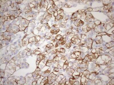 Immunohistochemistry: Cytokeratin 18 Antibody (3D1) [NBP2-45554] - Analysis of Carcinoma of Human kidney tissue.(Heat-induced epitope retrieval by 1mM EDTA in 10mM Tris buffer (pH8.5) at 120 oC for 3 min)
