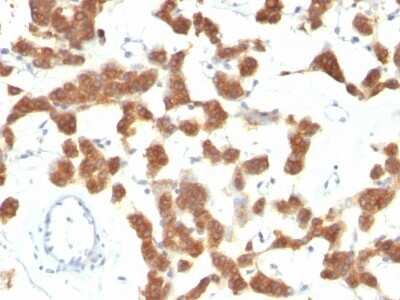 Immunohistochemistry-Paraffin: Cytokeratin 18 Antibody (B23.1) [NBP2-44952] - Human Thyroid Carcinoma stained with Cytokeratin 18 Monoclonal Antibody (B23.1).