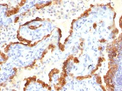 Immunohistochemistry-Paraffin: Cytokeratin 18 Antibody (Cocktail) - Azide and BSA Free [NBP2-47978] - Human Lung Ca stained with Cytokeratin 18 Mouse Monoclonal Antibody (Cocktail).