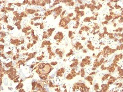 Immunohistochemistry-Paraffin: Cytokeratin 18 Antibody (Cocktail) - Azide and BSA Free [NBP2-47978] - Human Thyroid Ca stained with Cytokeratin 18 Mouse Monoclonal Antibody (Cocktail).
