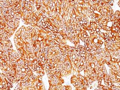 Immunohistochemistry-Paraffin: Cytokeratin 18 Antibody (Cocktail) - Azide and BSA Free [NBP2-47978] - Human colon carcinoma stained with Cytokeratin 18 Mouse Monoclonal Antibody (Cocktail).