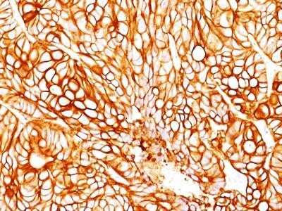 Immunohistochemistry-Paraffin: Cytokeratin 18 Antibody (DA7) - IHC-Prediluted [NBP2-44945] - Formalin-paraffin human colon cancer stained with Cytokeratin 18 Ab (DA7). Note cytoplasmic staining of tumor cells.