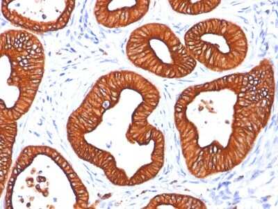 Immunohistochemistry-Paraffin: Cytokeratin 18 Antibody (DC10) - Azide and BSA Free [NBP2-33082] - Staining of human skin sweat gland. Note cytoplasmic staining of tumor cells.